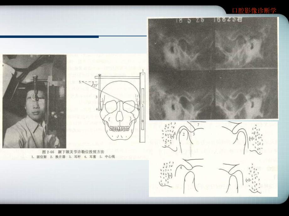 口腔颌面医学影像诊断学颞下颌关节疾病图文