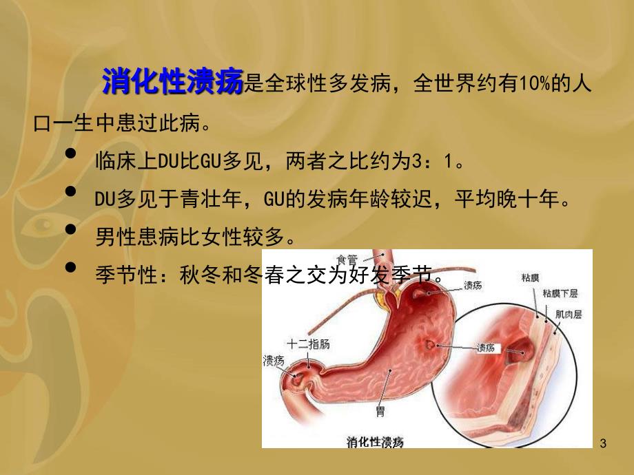 消化性溃疡病因与发病机制